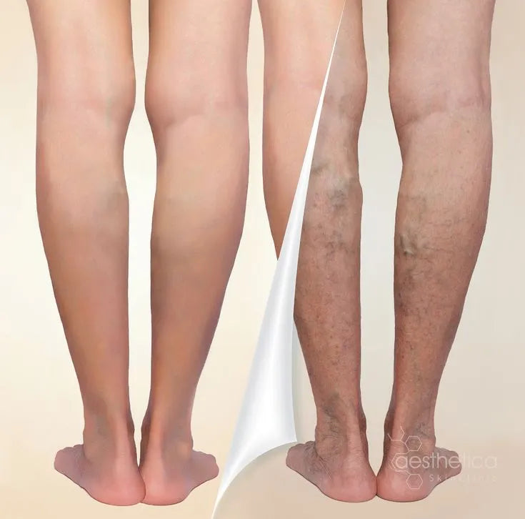 Crema para varices Alivio Instantáneo