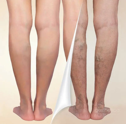 Crema para varices Alivio Instantáneo